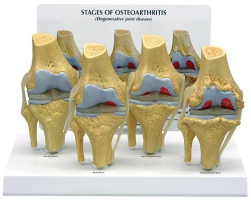 Four Stages of Osteoarthritis Model in The Knee Joint – Himkhand