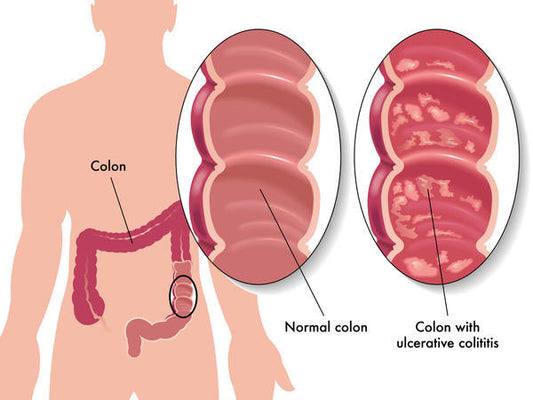 Asacol HD Tablets 800 mg Ulcerative Colitis Treatment (Rx)