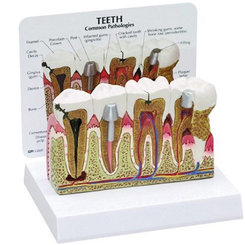 Diseased Teeth and Gums Model