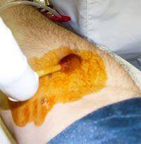 Povidone Iodine Solution Swabstick Antiseptic Applicators 3's
