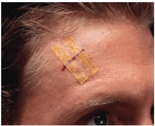 Steri-Strip Antimicrobial Skin Closures 1/8” x 3”