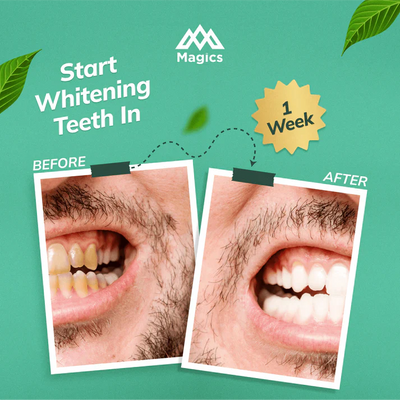 Magics PearlX Teeth Whitening Toothpaste ( Pack Of 2 ) | 100 gms each