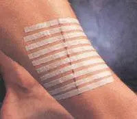Steri-Strip Reinforced Skin Closures R1547