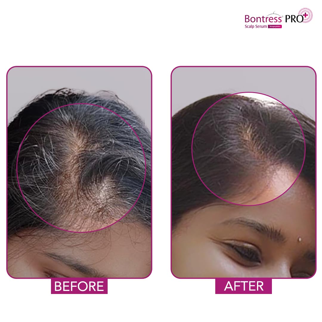 Bontress PRO+ Scalp Serum Fortified with 3% Redensyl, 3% Anagain, 4% Capixyl, 3% Procapil | Hair Serum for Hair Growth & Hair Fall 60ml