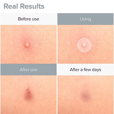 PRIVEDA Acne Pimple Patch 57 Units Hydrocolloid