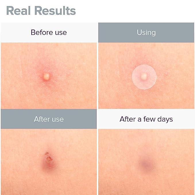 PRIVEDA Acne Pimple Patch 57 Units Hydrocolloid