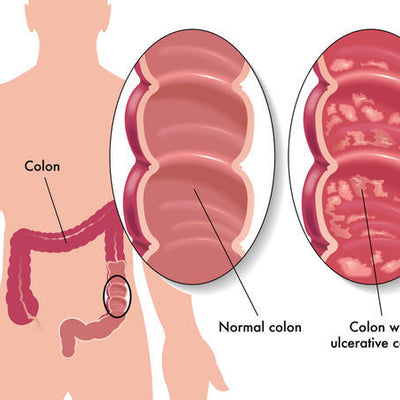 Asacol HD Tablets 800 mg Ulcerative Colitis Treatment (Rx)