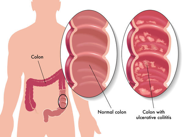 Asacol HD Tablets 800 mg Ulcerative Colitis Treatment (Rx)