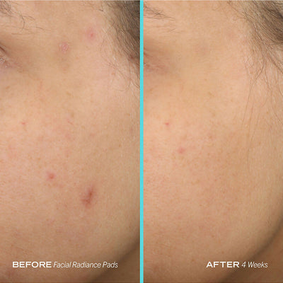 First Aid Beauty Facial Radiance Pads