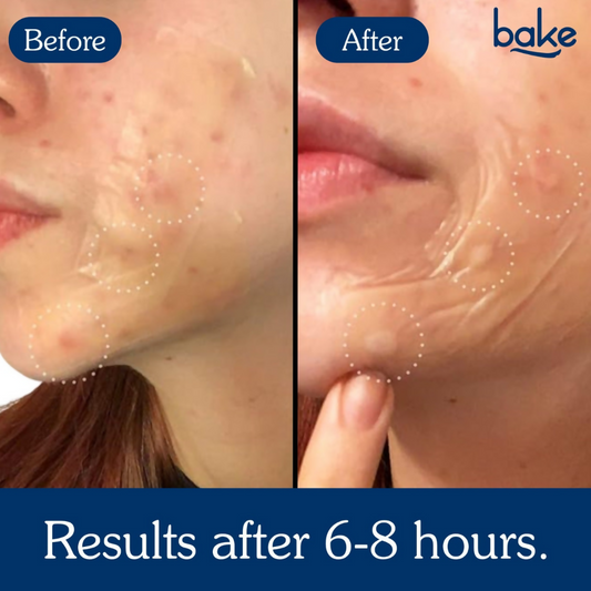 Bake Acne Erase XL Pimple Patches