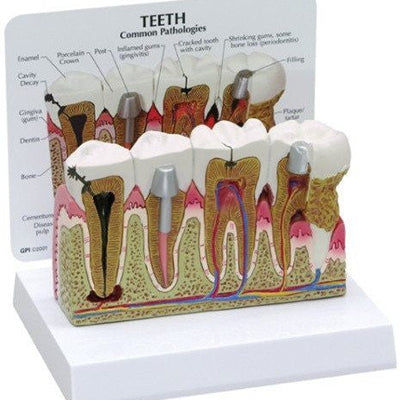 Diseased Teeth and Gums Model