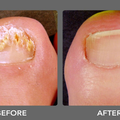 Kerasal Nail Fungal Nail Renewal Treatment