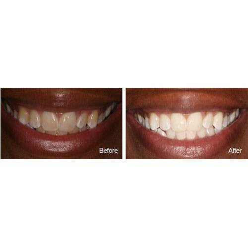 MI Paste with Recaldent 40 Gram Tube Tutti Frutti