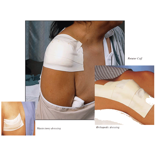 3M Microfoam Surgical Tape