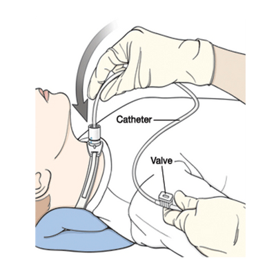 Suction Catheter, Straight with Thumb Control Whistle Valve