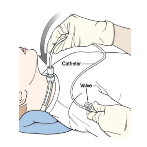 Suction Catheter, Straight with Thumb Control Whistle Valve