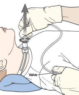 Suction Catheter, Straight with Thumb Control Whistle Valve